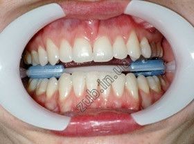 Ретрактор автоклавіруемий Артфлекс \ Arcflex FGM 518017985 фото