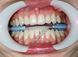 Ретрактор автоклавіруемий Артфлекс \ Arcflex FGM 518017985 фото 3